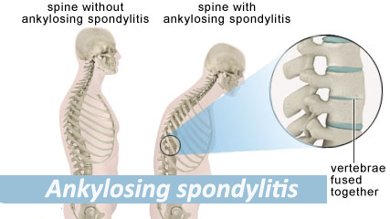 can you live a long life with ankylosing spondylitis
