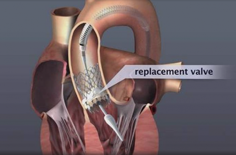 Transcatheter Heart Valves Hygeia Hospital