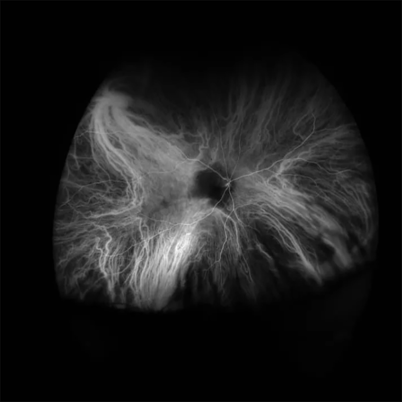OPTOS SILVERSTONE SS OCT INDOCYANINE GREEN ANGIOGRAPHY