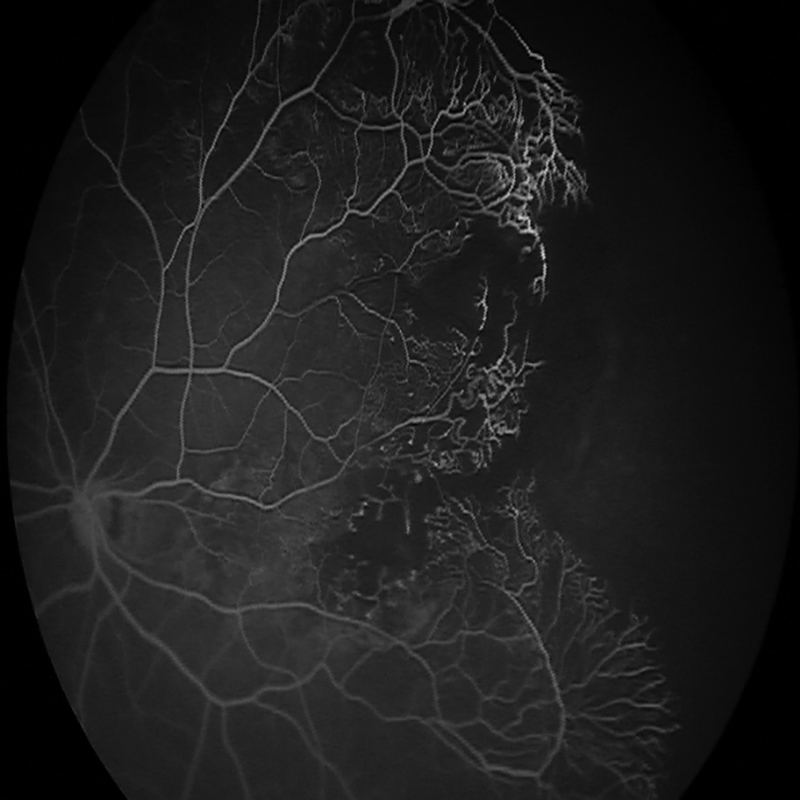 RETCAM ENVISION FLUORESCEIN ANGIOGRAPHY