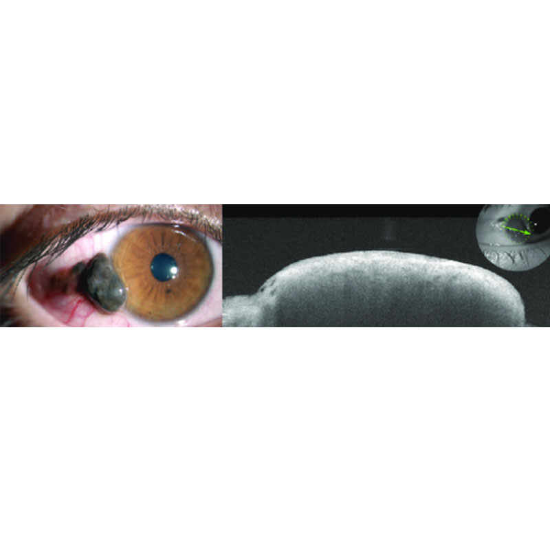 OPTOVUE VISIONIX SOLIX ANTERIOR SEGMENT OPTICAL COHERENCE TOMOGRAPHY (AS-OCT)